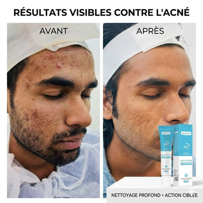 MOOYAM Anti-acné